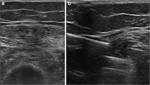 Ultrasound Guided Biopsy